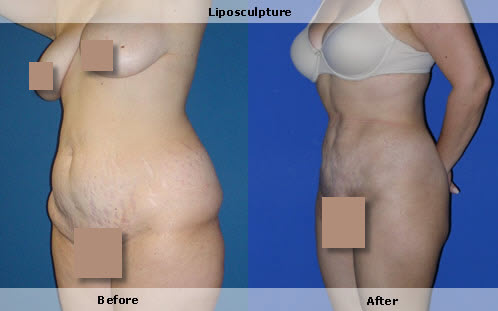liposuction, large amounts of fat removed